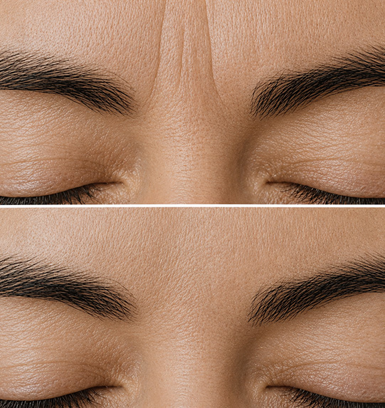 close-up of two foreheads showing smooth skin and fine lines variations for skin care analysis and anti-aging treatments targeting six key areas of concern