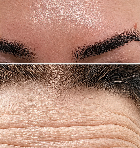 before and after jawline filler treatment showing improved appearance with fewer wrinkles and smoother skin results in enhancing facial features for beauty and rejuvenation 8 options for a youthful look