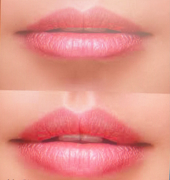before and after comparison of skin texture and appearance focusing on forehead wrinkles and brow area showing smooth skin results for beauty treatment 4 skin improvement techniques