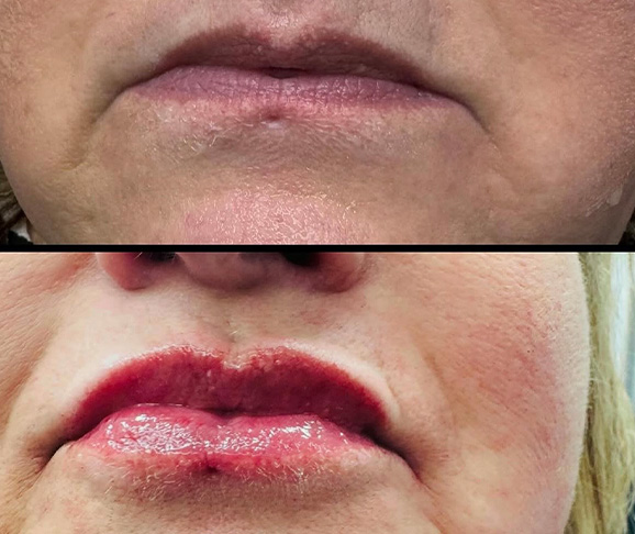 woman receiving an aesthetic treatment in a clinical setting facial rejuvenation procedure performed by a professional